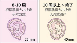杭州女性孕囊多大适合做人流？