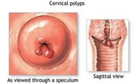 杭州女性如何判断自己是否患有宫颈息肉？